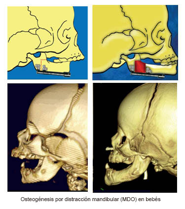 https://danishdecors.store/SiteCollectionImages/Infant_Mandibular_Distraction_Osteogenesis_es.jpg