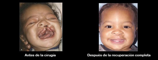 https://danishdecors.store/SiteCollectionImagesArticleImages/CleftbeforeAfter_Baby_es.jpg