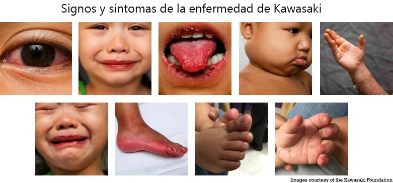 https://danishdecors.store/SiteCollectionImagesArticleImages/Signs_Symptoms_Kawasaki_Disease_es.jpg