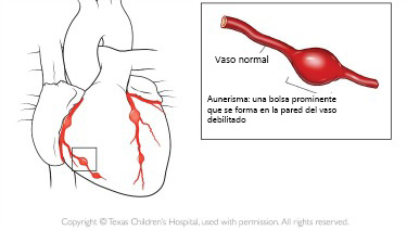 https://danishdecors.store/SiteCollectionImagesArticleImages/aneurysm_texaschildrens_es.jpg