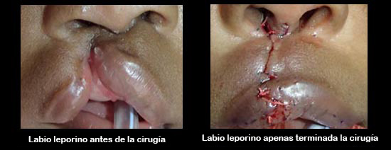 https://danishdecors.store/SiteCollectionImagesArticleImages/cleftLipBeforeAfter2_es.jpg